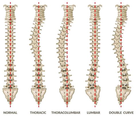 Scoliosis Treatment in West Omaha, NE | Kosak Chiropractic