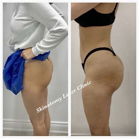 Sculptra Butt Lift - Non Surgical BBL Toronto - Skinatomy