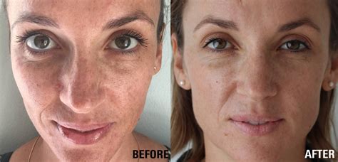 Before & After: How to Reverse Sun Damage and Pigmentation – Medico Beauty