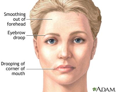 Facial drooping: MedlinePlus Medical Encyclopedia Image