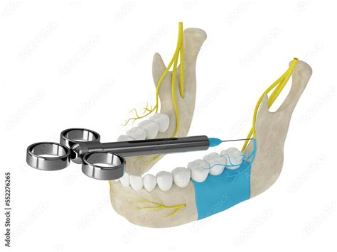 Buccal Nerve Block