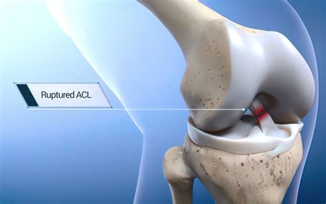 Understanding ACL Injuries: Causes, Symptoms, Treatment, and Prevention ...