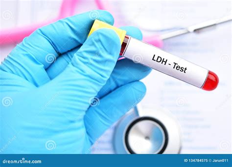 Blood Sample Tube for Lactate Dehydrogenase or LDH Test Stock Image - Image of liver, health ...