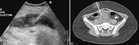 Ultrasound and CT as a method of image-guided drainage: (a) US guided ...