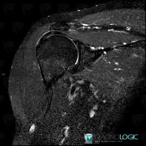 Radiology case : Bursitis (MRI) - Diagnologic