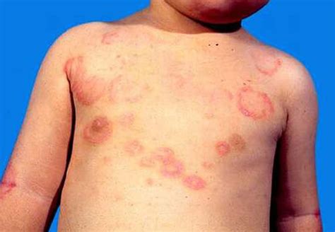 Erythema marginatum causes, symptoms, diagnosis & treatment