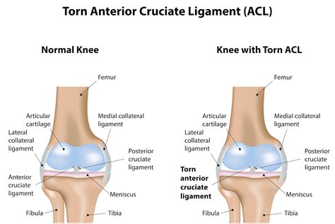 ACL Tear Prevention & Recovery Tips - Riverdale, NJ Chiropractor | Advanced Sports Medicine ...