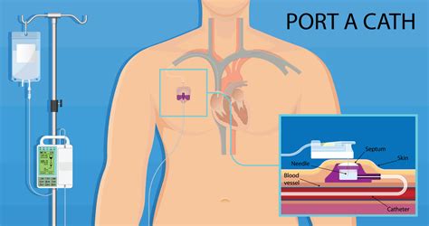 Implanted Venous Access Device (Port) | OncoLink