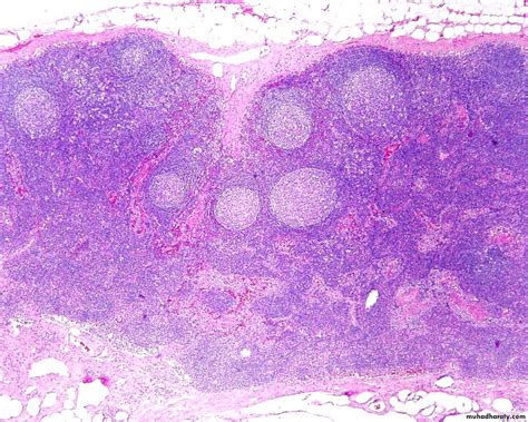 Pathology of lymph node pptx - D. Hameed - Muhadharaty