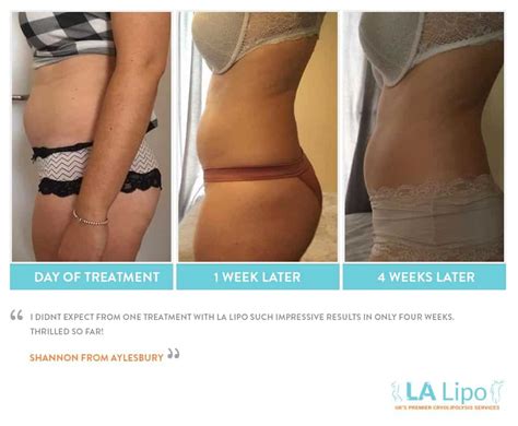 Before & After LA Lipo Cryolipolysis