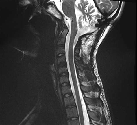 Pictures of Basilar Invagination | Brain & Spine Center