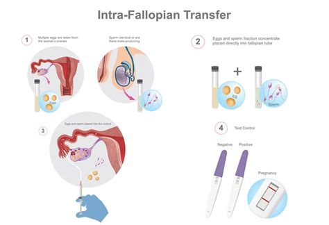 Gamete Intrafallopian Transfer - Procedure, Success Rate, Cost & more