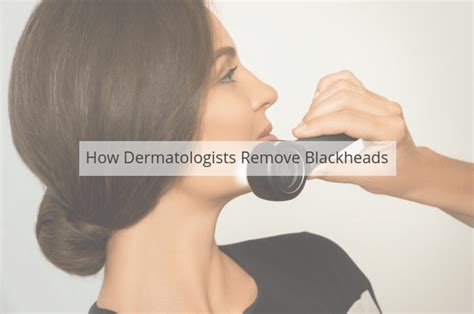 How Dermatologists Remove Blackheads? – UK-Dermatologist