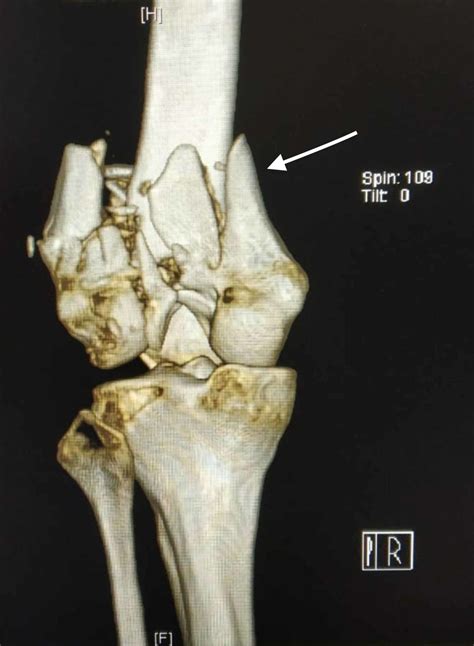 Distal Epiphysis Femur