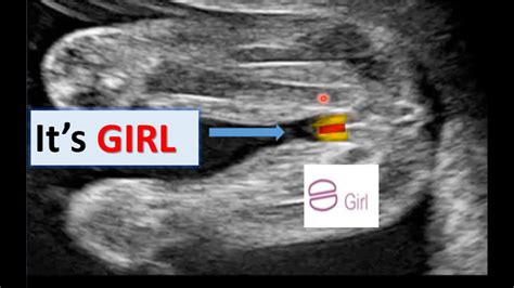 Ultrasound scan showing baby girl | it's baby girl|know your baby gender on ultrasound image ...