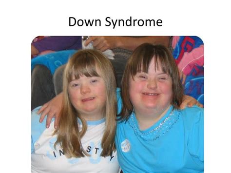 PPT - Down Syndrome ( trisomy 21) PowerPoint Presentation - ID:2170957