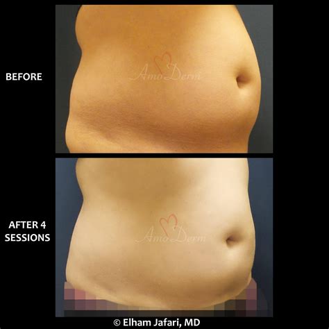 SculpSure | Non-Surgical Body Contouring Treatments in Irvine