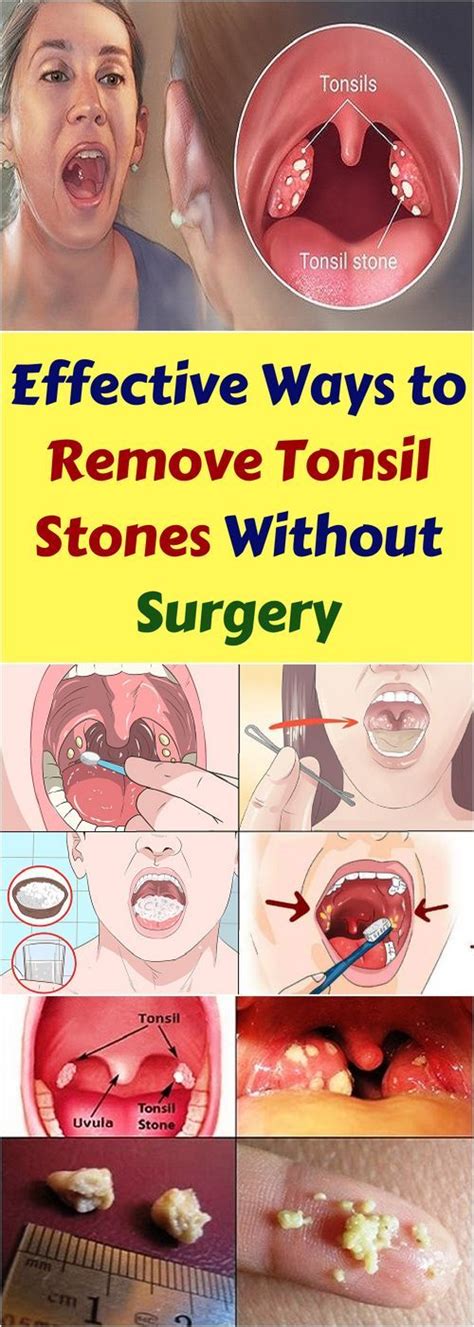 Let Start Slim Today: Effective Ways To Remove Tonsil Stones Without Surgery!!!