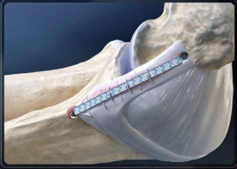 Ulnar Collateral Ligament Repair | UCL Reconstruction | Tommy John Surgery | Sugar Land ...