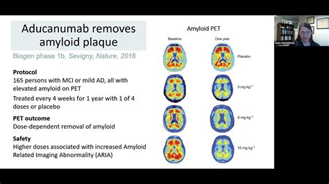 What’s New in Alzheimer’s Disease Clinical Trials? - YouTube