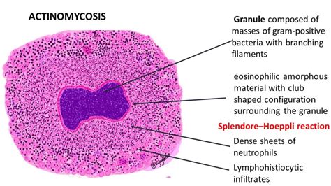 ACTINOMYCOSIS - Pathology Made Simple