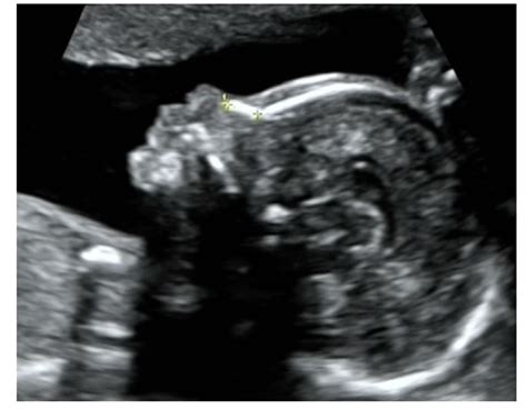 Nasal Bone Ultrasound 20 Weeks