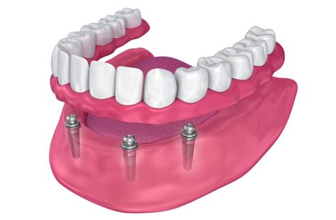 The Pros & Cons of Overdentures | Markham Dental Smiles