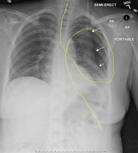 Southwest Journal of Pulmonary, Critical Care and Sleep - Imaging - Medical Image of the Week ...