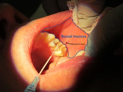 Buccal mucosa and Masticator space anatomy | Iowa Head and Neck Protocols