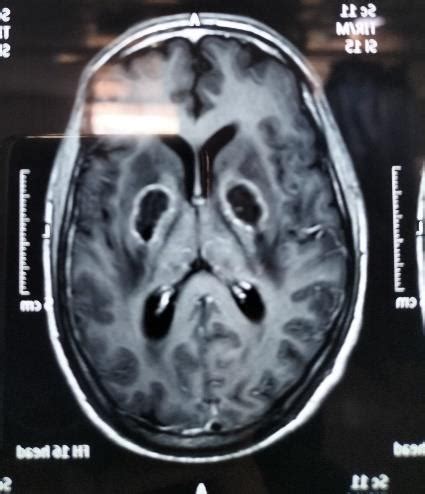 Figure1 and Figure 2-MRI images showing ring-enhancing lesions | Download Scientific Diagram