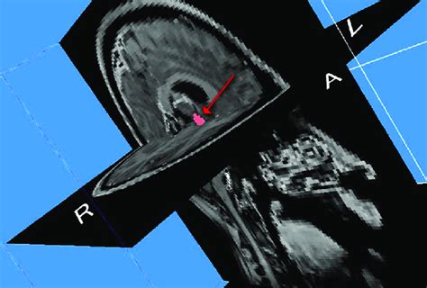 MRI reconstruction demonstrating the spatial location of the ...