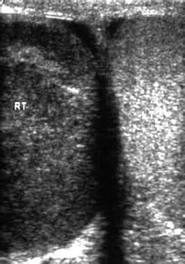 Testicular Seminoma Ultrasound