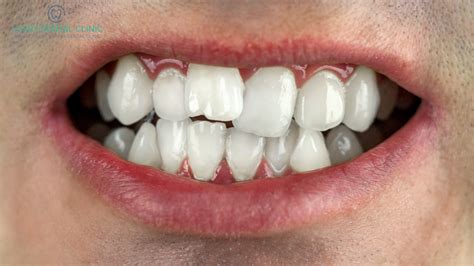 Your Overcrowded Teeth: Causes, Symptoms, and Solutions