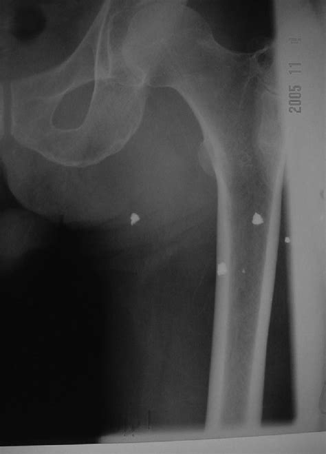 The plain radiograph of the left hemipelvis. | Download Scientific Diagram