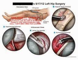 Medical Treatment Pictures-for Better Understanding: Arthroscopic Hip Synovectomy Surgery ...