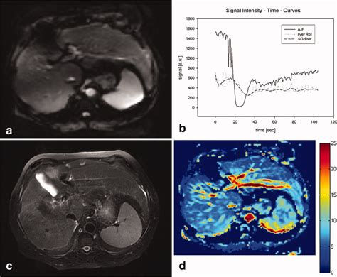 Feasibility of semiquantitative liver perfusion assessment by ferucarbotran bolus injection in ...