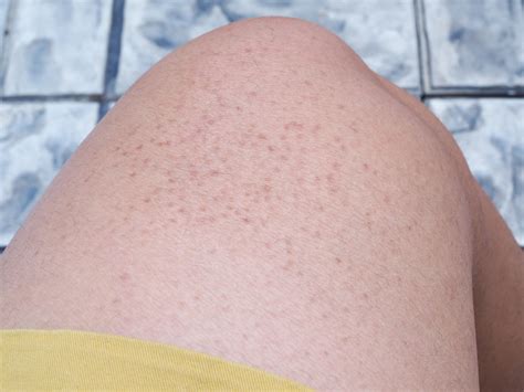 Gluten And Keratosis Pilaris AKA Chicken Skin Rash - Amy Burkhart, MD, RD