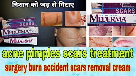 mederma cream uses || acne pimples scars || surgery accident scars ...