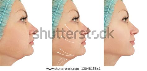 Woman Chin Lift Before After Procedures Stock Photo (Edit Now) 1304815861