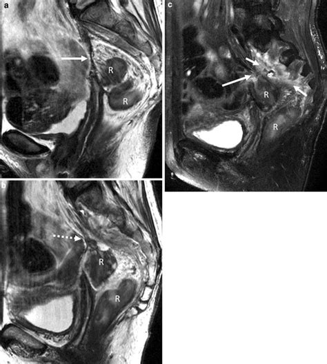 Sagittal T2-weighted (T2w) images (a, b) demonstrating sacrocolpopexy ...