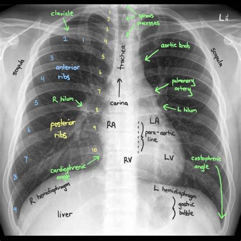 How to Read Chest X-Ray - FreeMedicalMCQs.com