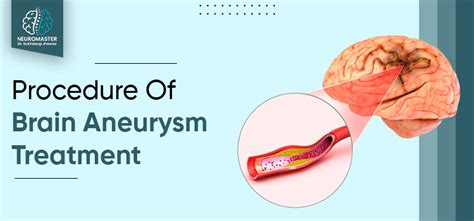 What Is Brain Aneurysm And How Does A Neurosurgeon Treat It?