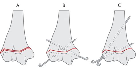 elbow fracture | mybioscience scientific illustrations