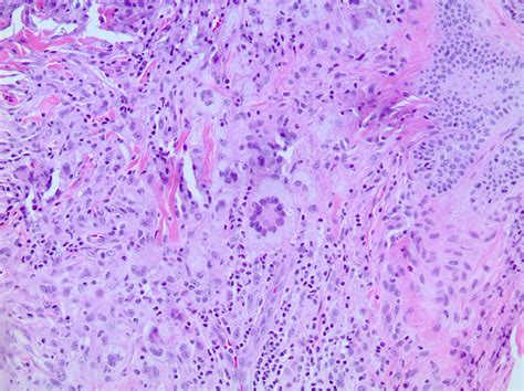 Pathology Outlines - Juvenile xanthogranuloma