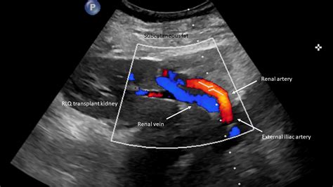 Renal Transplant Anatomy