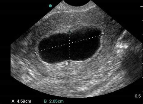 Amniotic Sac Ultrasound