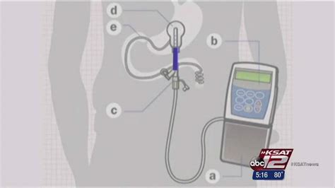 DUOPA for Parkinson's Patients