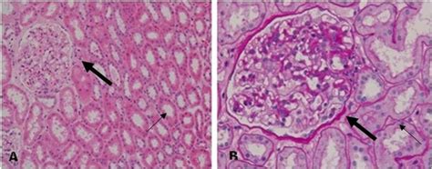 What Is Thin Basement Membrane Disease - Openbasement