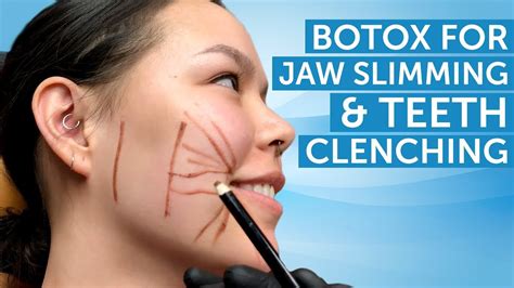 Botox for Jaw Slimming and Teeth Clenching | AAFE - YouTube