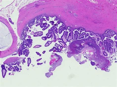 Ampulla Of Vater Histology